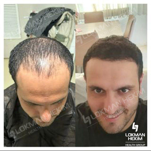 زراعة الشعر صور قبل وبعد